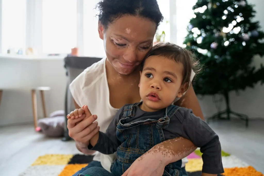 Mor med vitiligo holder sit barn tæt i et lyst hjemmemiljø.